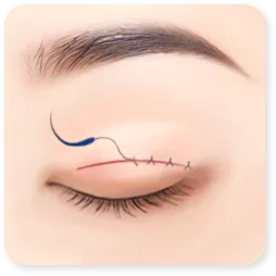 Gambar langkah 3 dari klinik: sayatan di lipatan ditutup dengan jahitan halus.