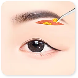 ภาพขั้นที่ 2 ของคลินิก: ตัดผิวออกผ่านแผลใต้คิ้ว