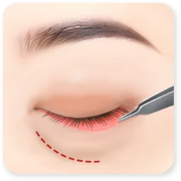 Gambar langkah 1 dari klinik tentang kelopak mata bawah, saat septum dibuka dan cekungan dilepaskan.
