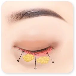 Gambar langkah 2 dari klinik tentang kelopak mata bawah, dengan lemak yang sudah dipindahkan ke dalam cekungan.