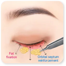 Gambar langkah 3 dari klinik tentang kelopak mata bawah, dengan septum yang tertutup dan lemak yang tertahan di tempat barunya.