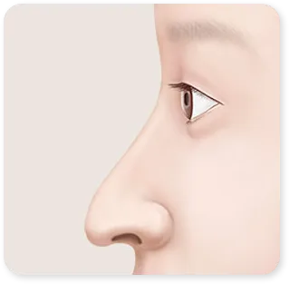 ภาพจมูกยาวของคลินิก จากส่วนในหน้าเว็บที่อธิบายว่าจมูกยาวคืออะไร