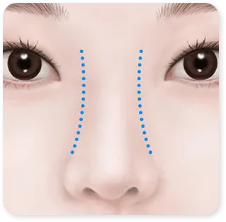Hình minh họa của phòng khám cho phần giải thích sống mũi rộng là gì.