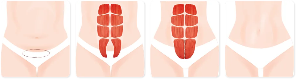 Urban Plastic Surgery drawing of a mini abdominoplasty in four panels: a small oval of lower belly skin marked for removal, the separated muscles below the belly button, the muscles stitched together and the flatter belly after.