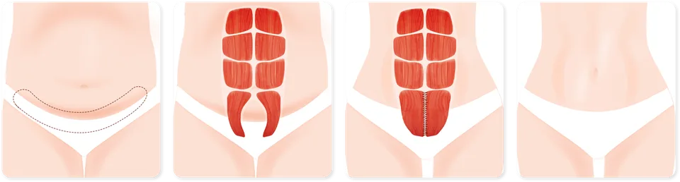 Urban Plastic Surgery drawing of a medium abdominoplasty in four panels: a wider crescent of lower belly skin marked for removal, the separated muscles below the belly button, the muscles stitched together and the flatter belly after.