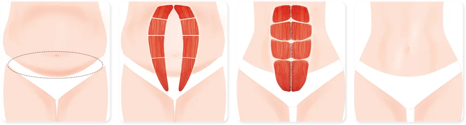 Urban Plastic Surgery drawing of a full abdominoplasty in four panels: a wide band of skin marked from above the belly button, the muscles separated along their whole length, the muscles stitched from top to bottom and the flatter belly after.