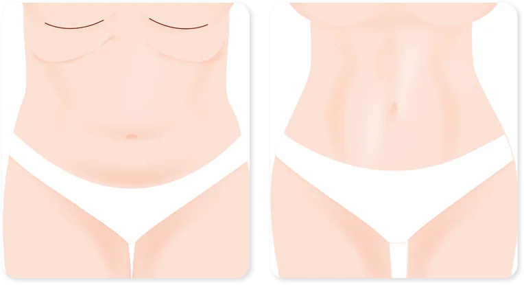 Urban Plastic Surgery drawing of an upper abdominoplasty in two panels: the cut lines marked along the creases under the breasts, and the smoother upper belly after.